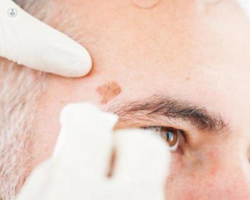 la-importancia-de-revisar-las-manchas-en-la-piel imagen de artículo