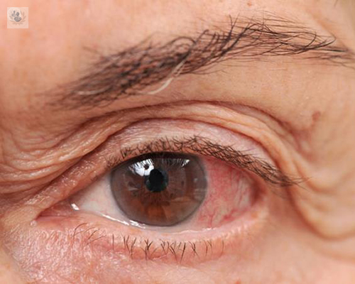 tipos-de-desprendimiento-de-retina imagen de artículo