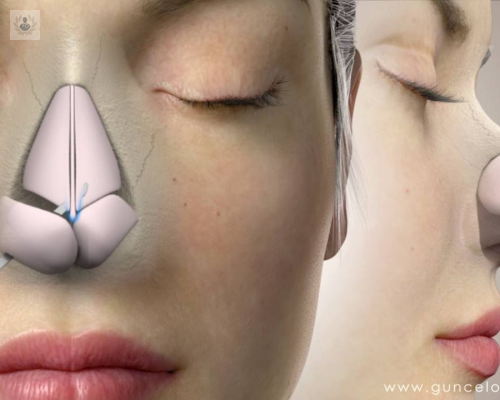 conoces-los-tipos-de-rinoplastia imagen de artículo