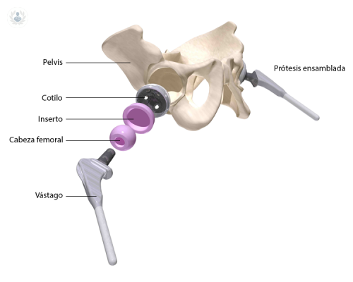 en-que-consiste-la-cirugia-de-protesis-de-cadera imagen de artículo