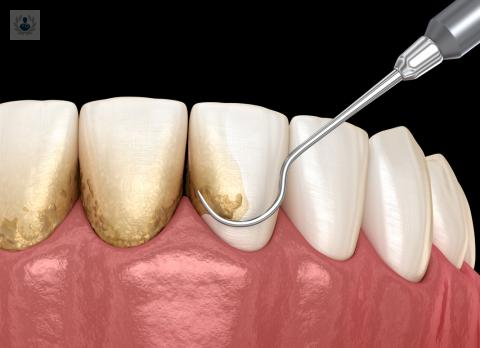 que-hacer-contra-el-sarro-dental imagen de artículo