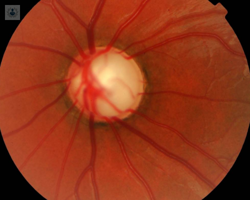 El Glaucoma puede provocar ceguera