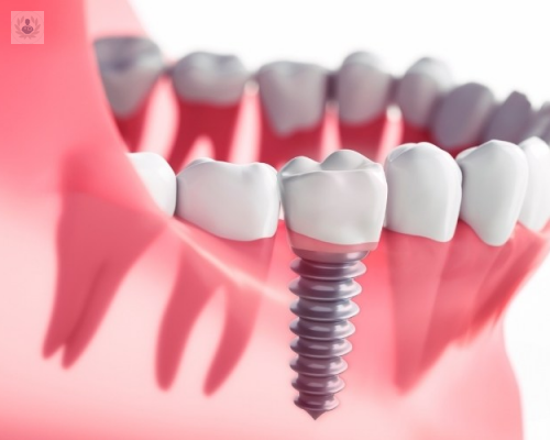 Beneficios de los Implantes Dentales de Carga Inmediata