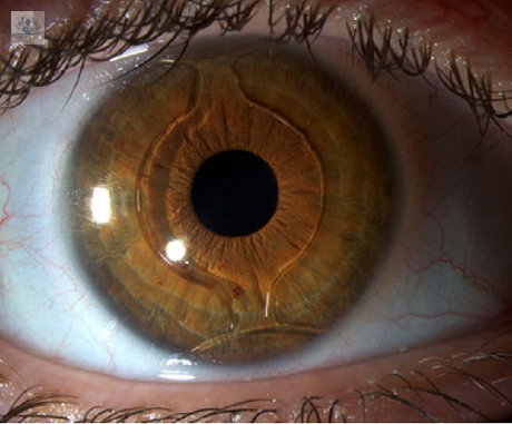 lente-intraocular-ipcl-tratamiento-rapido-y-efectivo imagen de artículo