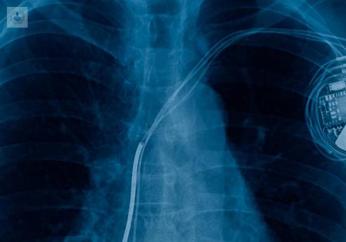 en-que-consiste-la-implantacion-de-un-desfibrilador-interno imagen de artículo