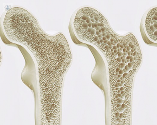 tengo-osteoporosis-que-hago imagen de artículo