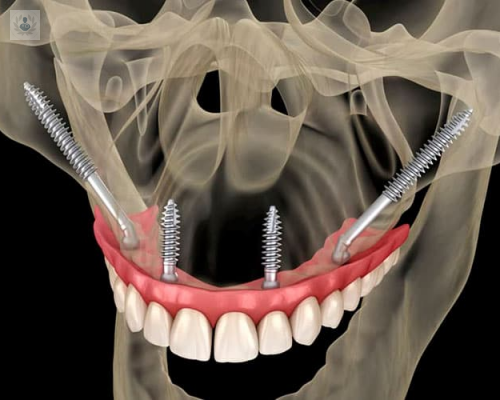 ¿Cómo sustituir los dientes caídos?