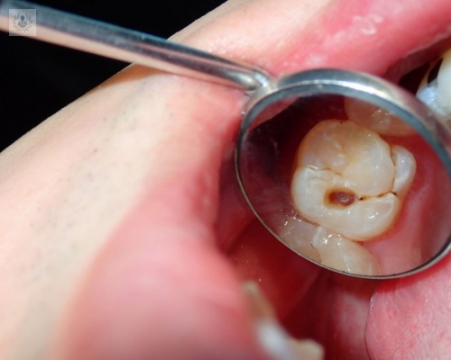 Síntomas y causas de la Caries Dental