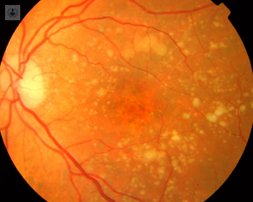 Degeneración Macular: síntomas y tratamiento