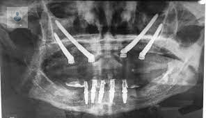 Implantes Cigomáticos, la solución para los casos imposibles