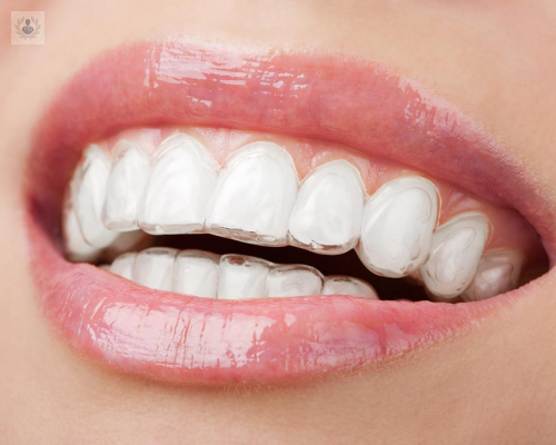 ¿Por qué elegir Invisalign?