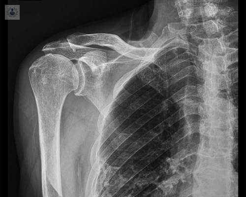 rotura-del-manguito-rotador-o-del-tendon-del-supraespinoso imagen de artículo