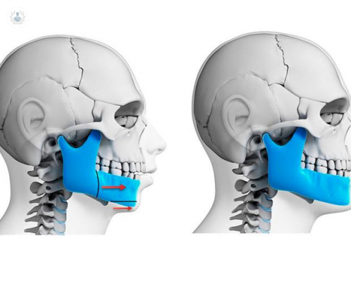 cirugia-ortognatica-en-el-tratamiento-de-la-apnea-obstructiva-del-sueno imagen de artículo