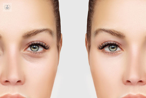Treatment of dark circles and restore the brightness of the eyes