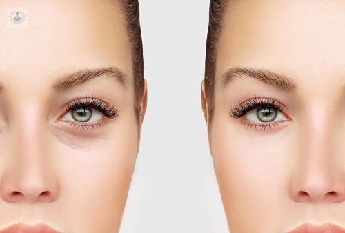 tratamiento-de-ojeras-y-restauracion-de-la-luminosidad-de-la-mirada imagen de artículo
