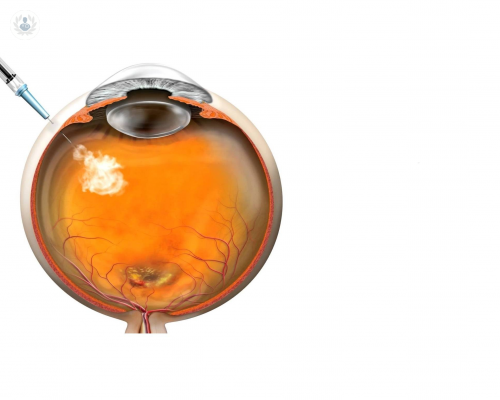 inyecciones-intravitreas-para-el-tratamiento-de-patologias-oculares imagen de artículo