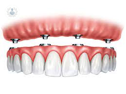 Implantes Dentales de Carga Inmediata para casos estables y estéticos