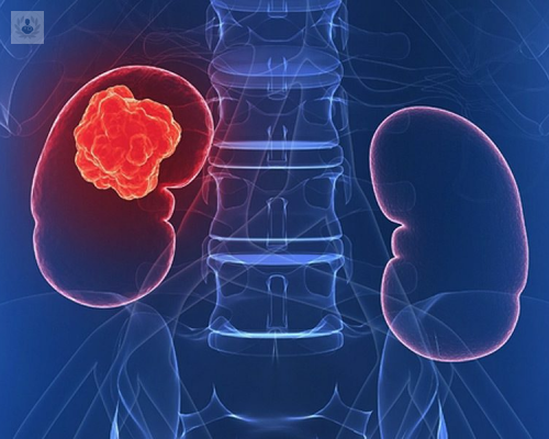 Addressing kidney cancer