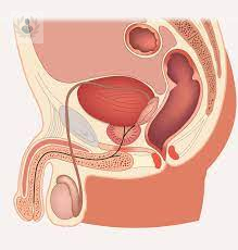 que-es-y-como-se-trata-la-hiperplasia-benigna-de-prostata imagen de artículo