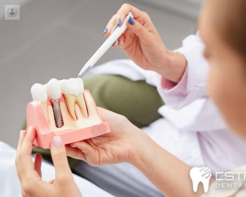 Implantes Dentales: Recupera tu dentadura
