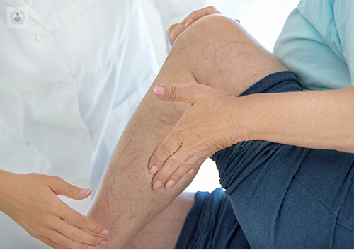 varices-padecimiento-hereditario imagen de artículo