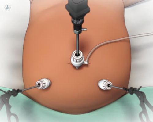 laparoscopia-ginecologica-diagnostico-y-tratamiento-de-enfermedades-ginecologicas imagen de artículo