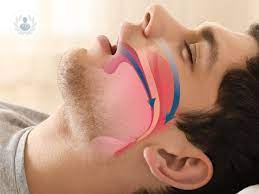 Sleep apnea: airway obstruction while sleeping (P2)
