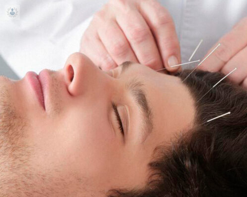 que-es-la-acupuntura-y-como-nos-beneficia imagen de artículo