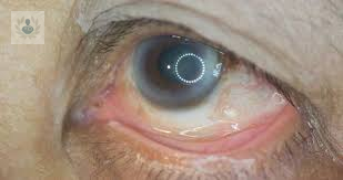 retinopatia-diabetica-como-se-ve-afectada-nuestra-vision-con-la-diabetes imagen de artículo