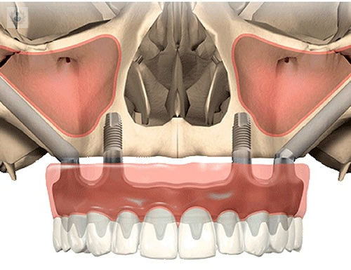 Implantes Cigomáticos: Alternativa a las Prótesis Dentales