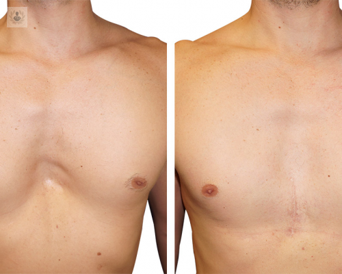 que-es-el-pectus-excavatum-y-como-podemos-tratarlo imagen de artículo