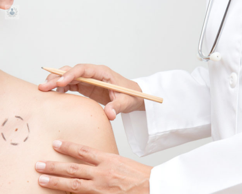 conoce-cuales-son-los-sintomas-del-melanoma-y-como-podemos-prevenir-este-tipo-de-cancer imagen de artículo