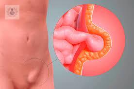 que-es-la-hernia-inguinal imagen de artículo