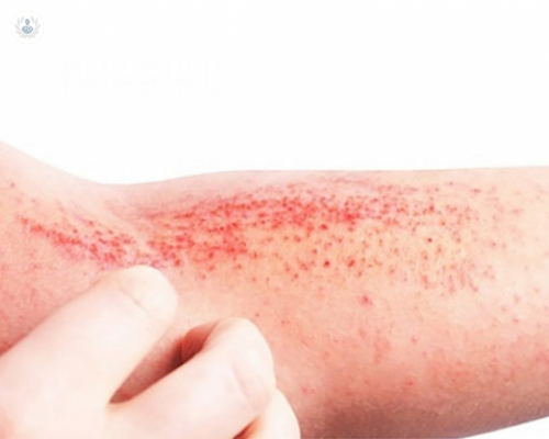 ¿Qué es la Dermatitis de Contacto?