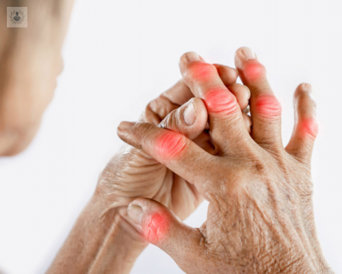 ¿Qué es la Artritis Reumatoide y cuáles son sus síntomas?