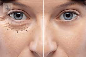 blefaroplastia imagen de artículo