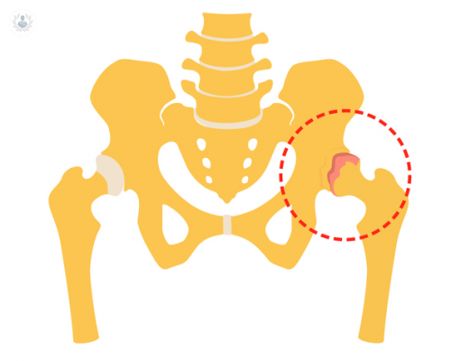 displasia-de-cadera imagen de artículo