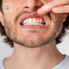 causas-de-la-gingivitis imagen de artículo