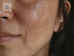 que-es-el-melasma imagen de artículo