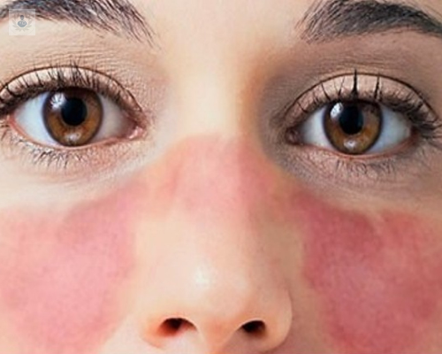 que-es-el-lupus imagen de artículo