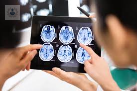 tumores-cerebrales-como-tratar-los-benignos-y-los-malignos-parte-1 imagen de artículo