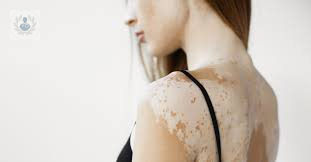 Vitiligo: ¿Existe cura? (Parte 1)