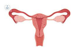 What is Adenomyosis?