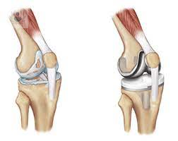 artroplastia-de-rodilla-cirugia-de-reemplazo-total-de-articulacion imagen de artículo