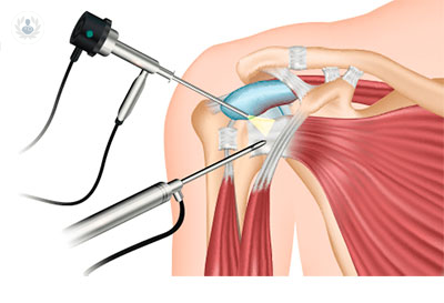 lesiones-del-hombro-tratamientos-vanguardistas-parte-2 imagen de artículo