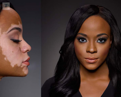 vitiligo-existe-una-cura-parte-2 imagen de artículo