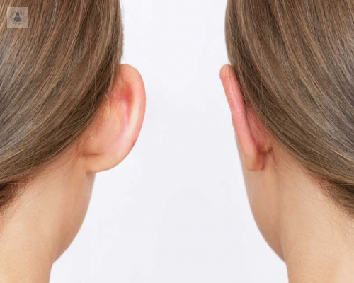 otoplastia-para-que-sirve imagen de artículo