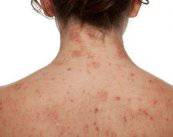 Dermatitis Atópica: reacción alérgica de la piel (Parte 1)