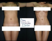 lipolaser-que-es imagen de artículo