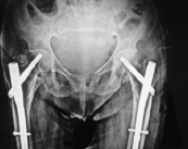 fractura-de-cadera-en-el-adulto-mayor-tratamiento-y-prevencion imagen de artículo